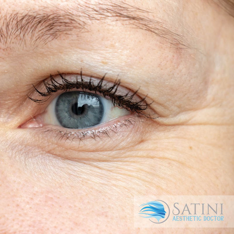 PRP plasma facial eyes-before and after image-Botox clinic near me-Christchurch