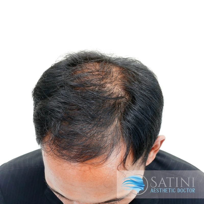 Before PRP Platelet Rich Plasma For Male Baldness-Botox Clinic Near Me- Christchurch