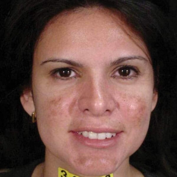 Before Cosmelan Treatment. Book Now.