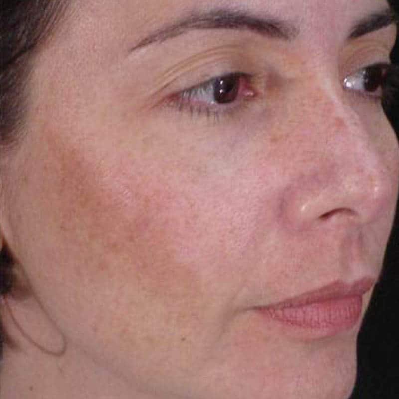 Before Cosmelan Peel-Botox Clinic Near Me-Cosmelan Peel Near Me