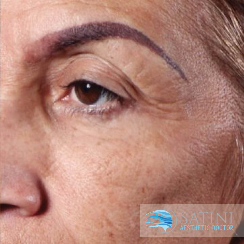 After Blood Facial For The Eyes-Botox Clinic Near Me-Christchurch
