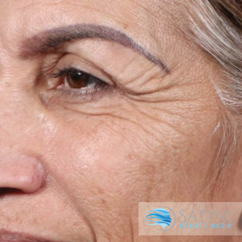 Blood Facial For Eyes-Botox Clinic Near Me-Christchurch