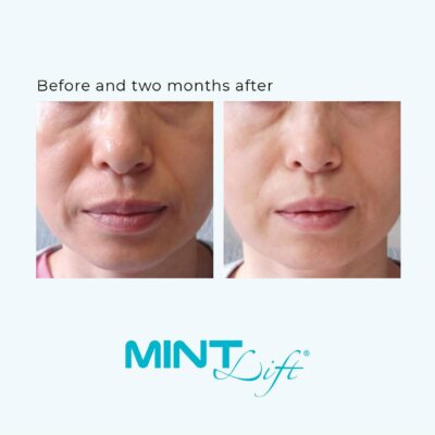 MINT Facelift MINT Thread Lift Before And After