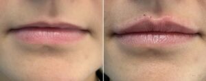 MINT Thread Lip Before And After MINT Thread Lip Enhancement