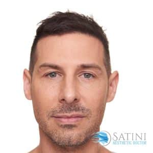 Man after dermal filler