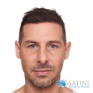 Man before dermal filler