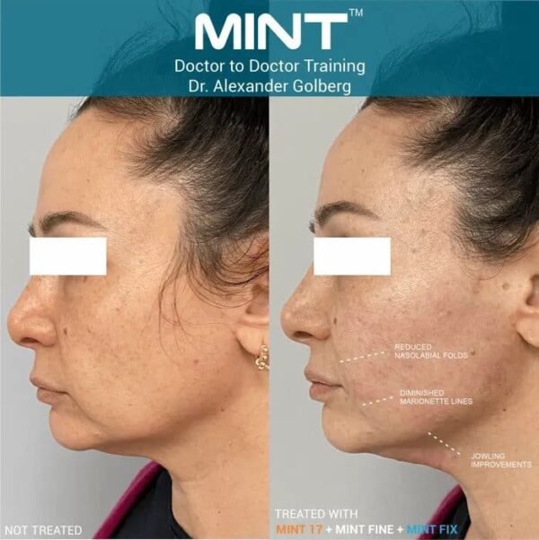 MINT-Thread-Before-And-After-1 MINT Thread Lift Before And After