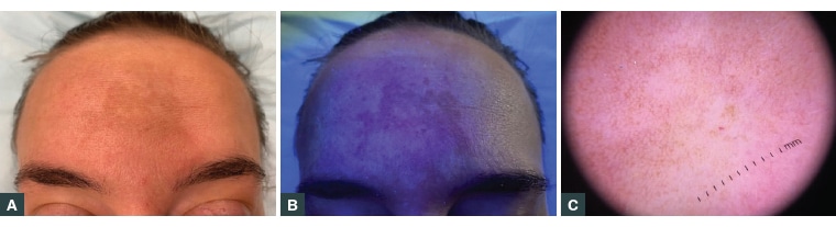 Melasma, photo 1 melasma-how to treat melasma