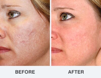 MINT Threads for acne scars Before and after MINT Threads for acne scars-Botox Clinic Christchurch-Botox Near Me