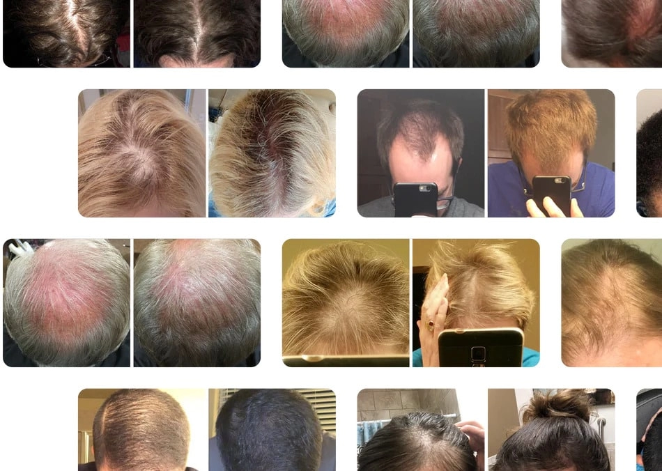 Before And After iRestore laser helmet for hair loss Before And After iRestore laser helmet for hair loss