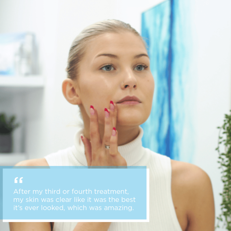 Microneedling