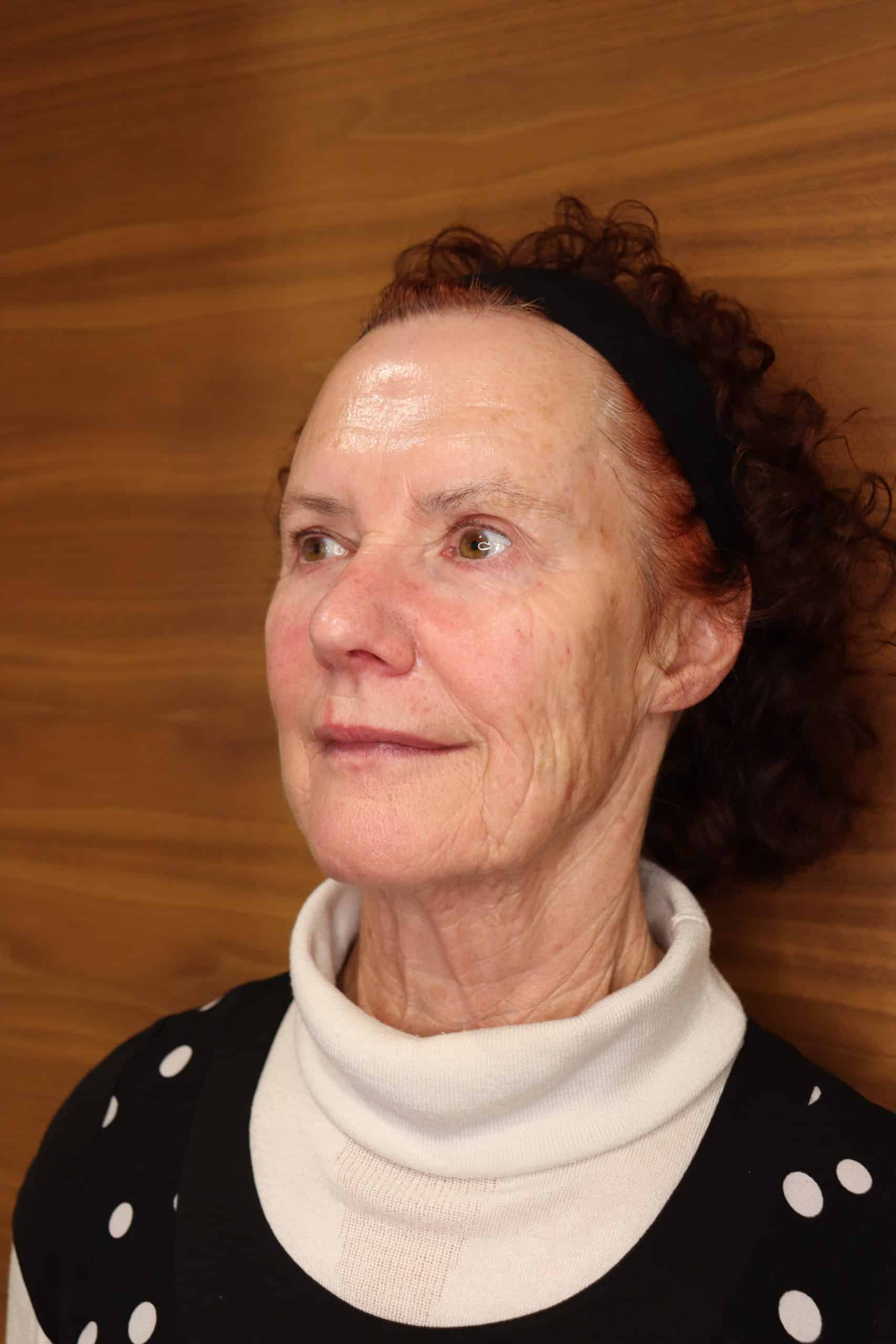 After Tear Trough Filler