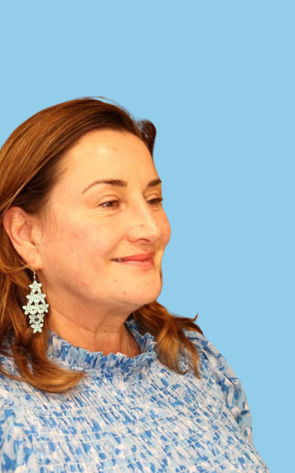 Annette after her dermal filler treatment