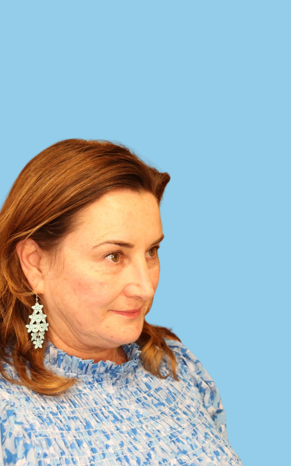 Anette after dermal filler