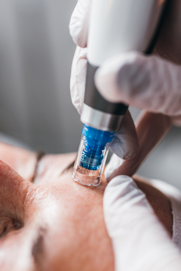 Dermapen Microneedling 3 Session Package - Image 2