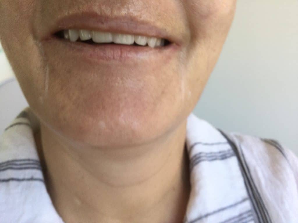 Before Dermal Filler for the lips