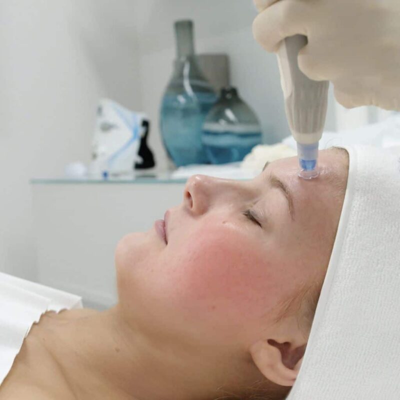 dermapen 4 Microneedling -derma pen