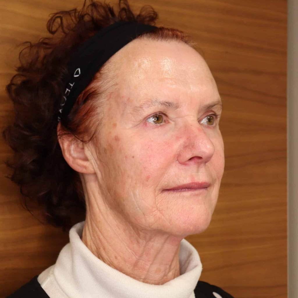 Glenda after dermal filler on Christchurch