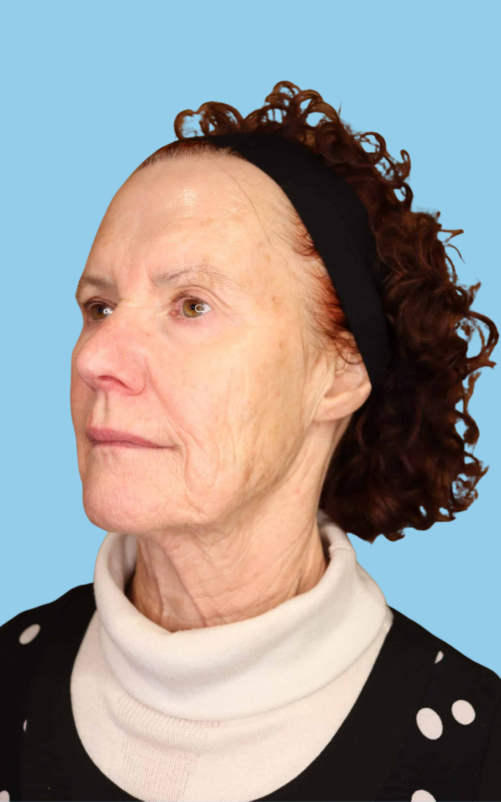 Glenda before dermal filler Glenda before dermal filler at Satini Cosmetic Clinic