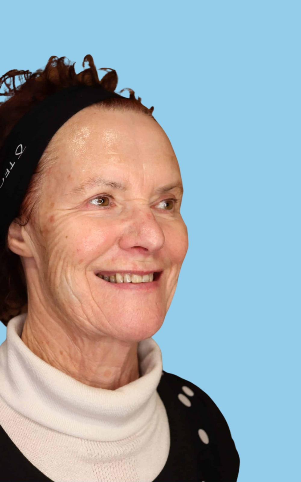 Satini Cosmetic Clinic Christchurch, our clients Glenda, a client at Satini Cosmetic Clinic