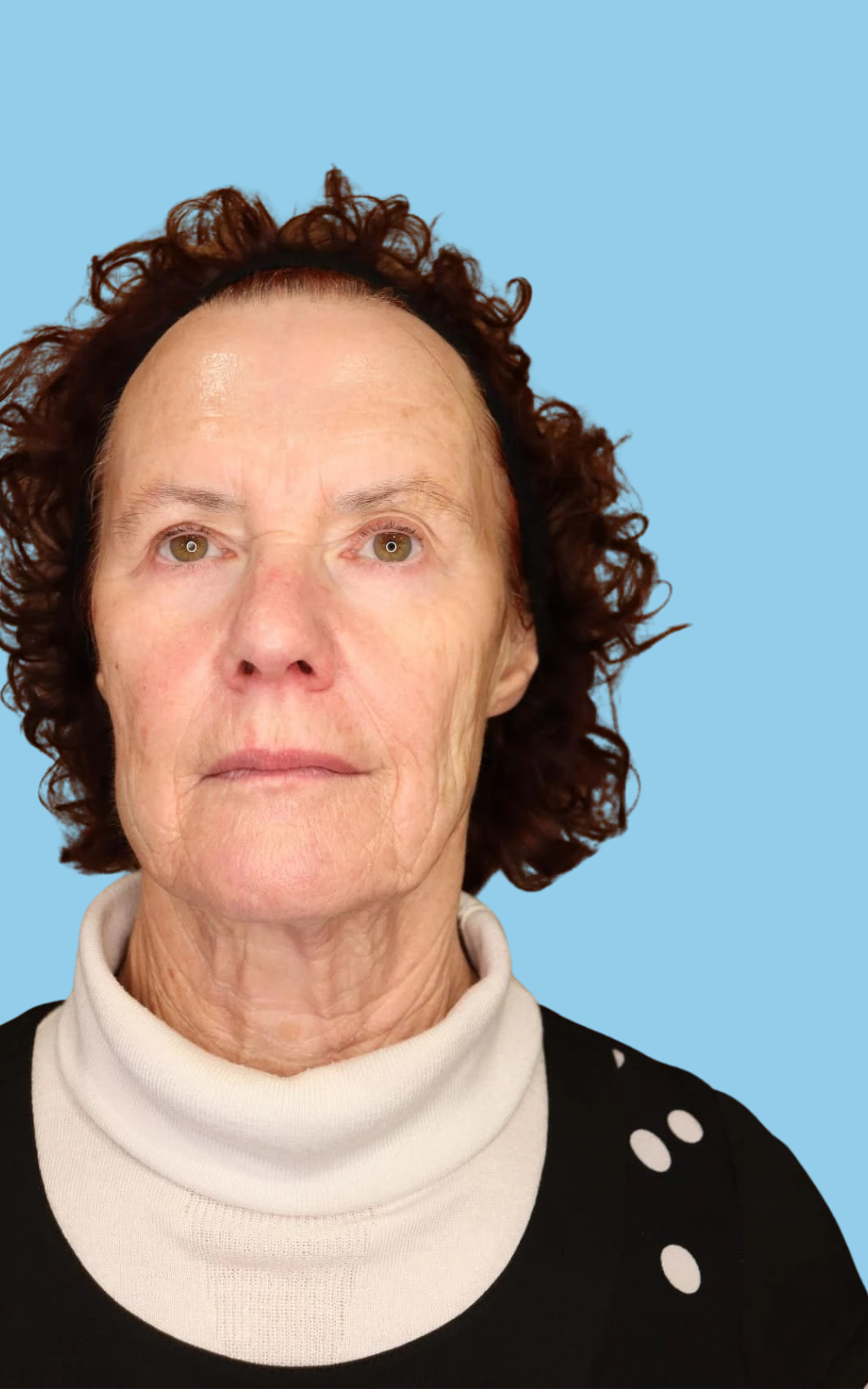 Glenda after dermal filler at Satini Cosmetic Clinic Christchurch