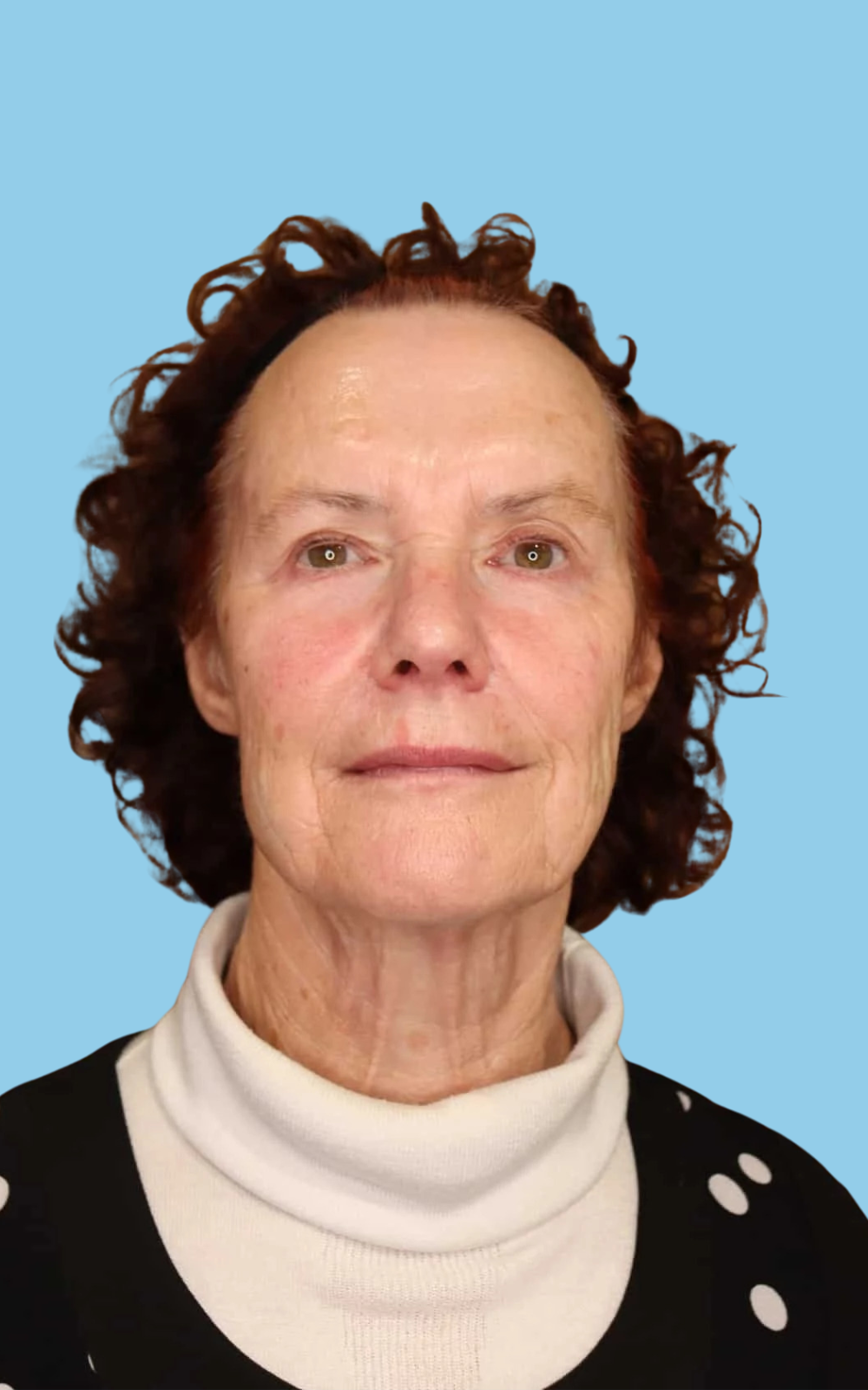 Glenda after dermal filler, frontal picture