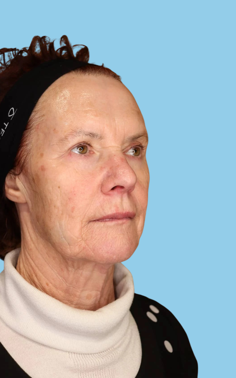 Glenda after dermal filler by Dr Nadja Haub