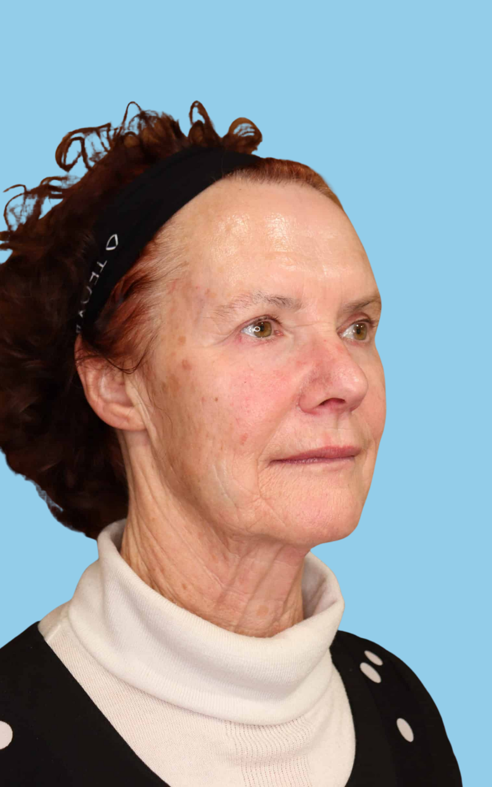 Glenda after dermal filler at Satini Cosmetic Clinic, right side