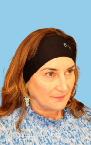 dermal filler for a 50 year old woman 50 year old woman who gets dermal filler regularly