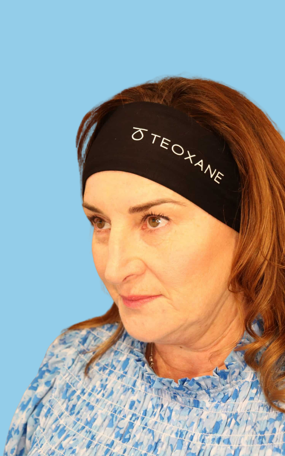 Anette Before Dermal Filler