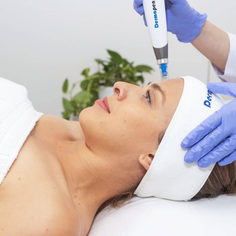 microneedling-collagen induction therapy needling face-dermapen 4