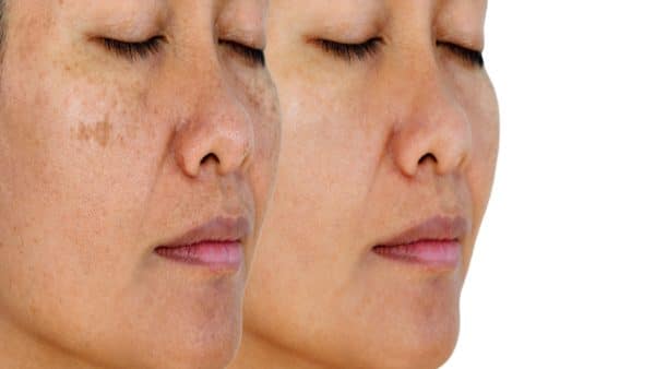 melasma cream What is melasma
