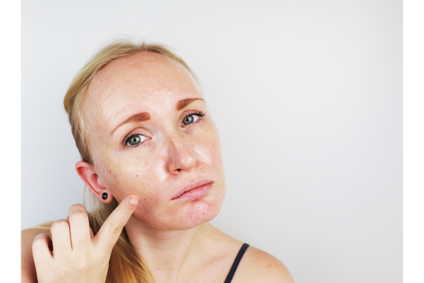 Cosmelan Peel