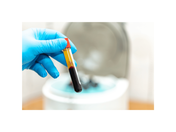 PRP Plasma Vial Blood Facial Christchurch-PRP-Plasma