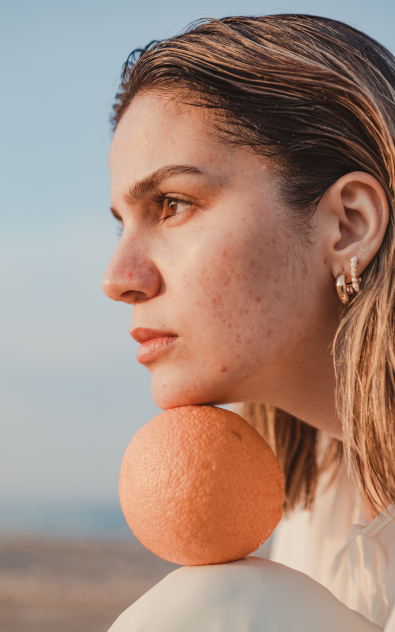 Microneedling with dermapen 4 Microneedling For Acne Scars Christchurch