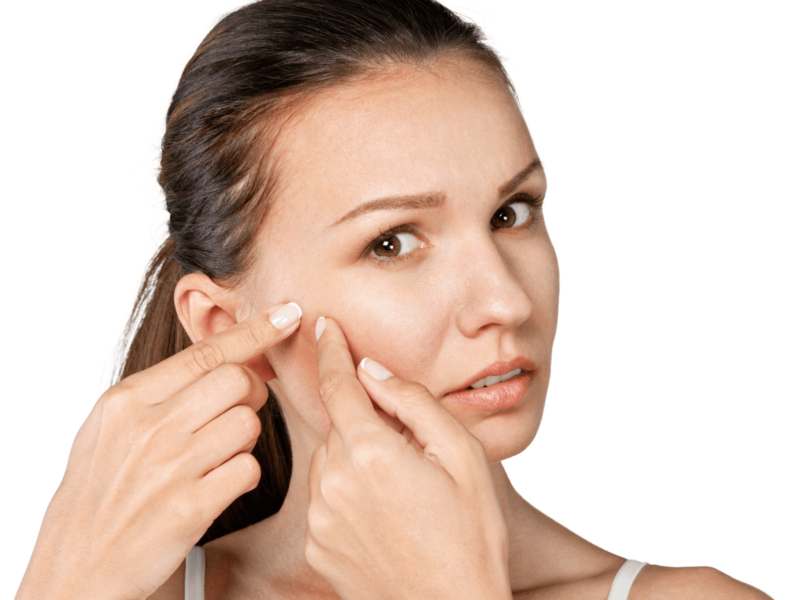 Microneedling For Acne Scars Woman with acne scars