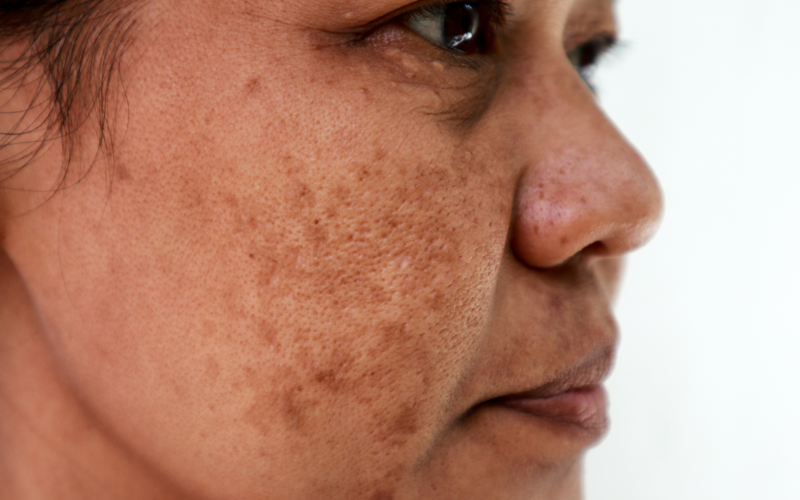 Hyperpigmentation of the cheeks