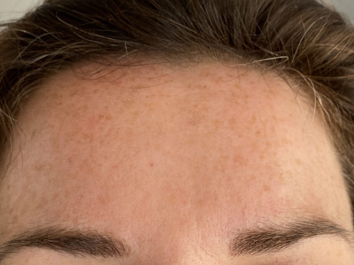 Before Botox For frown Lines, middle aged woman