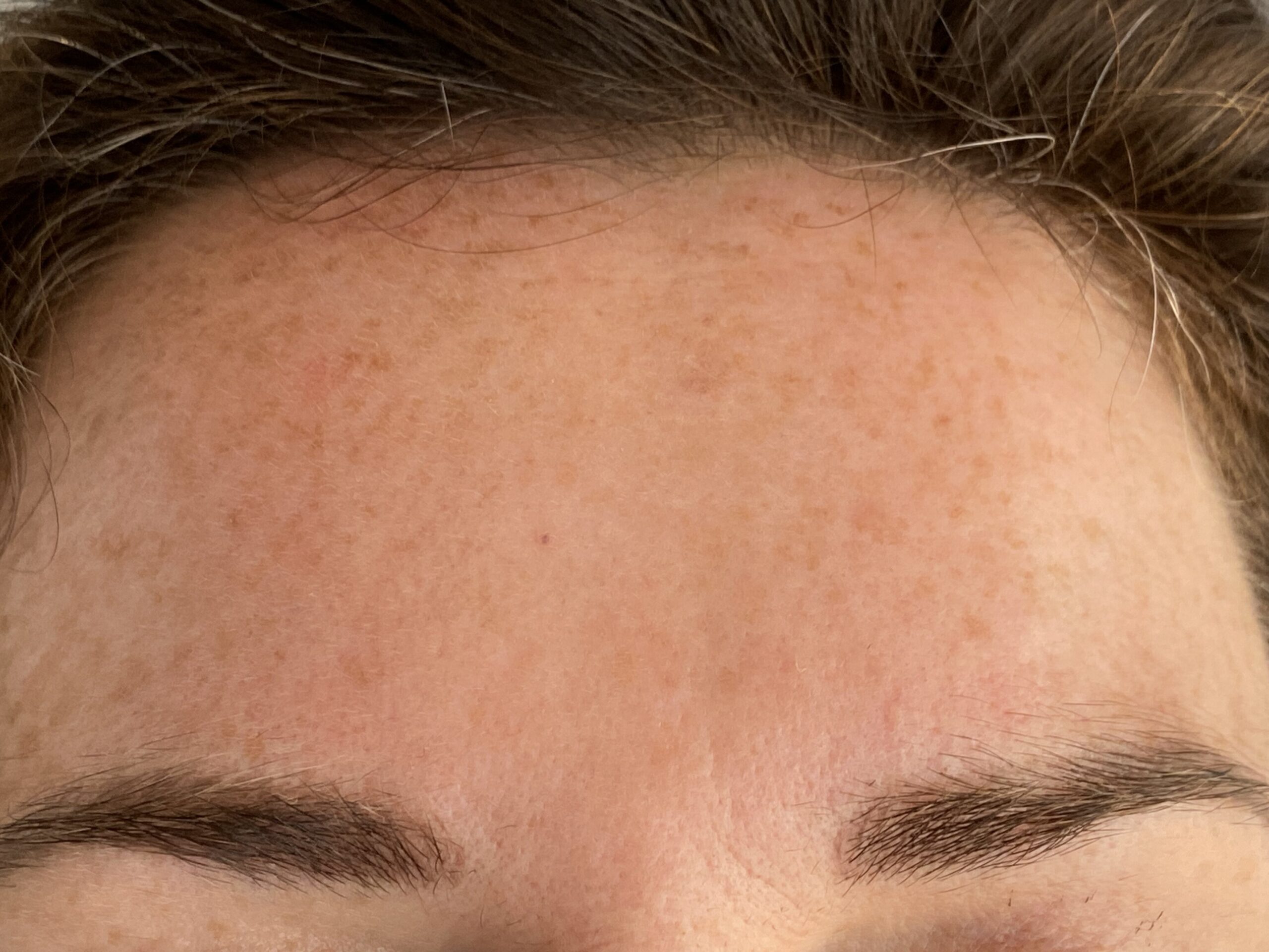 After Botox For Frown Lines