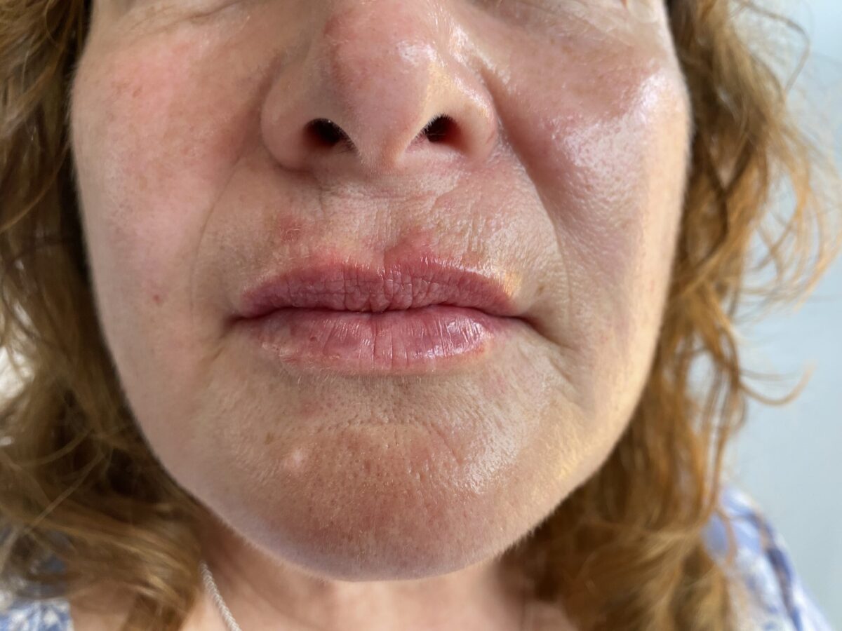 After lip fillers chch