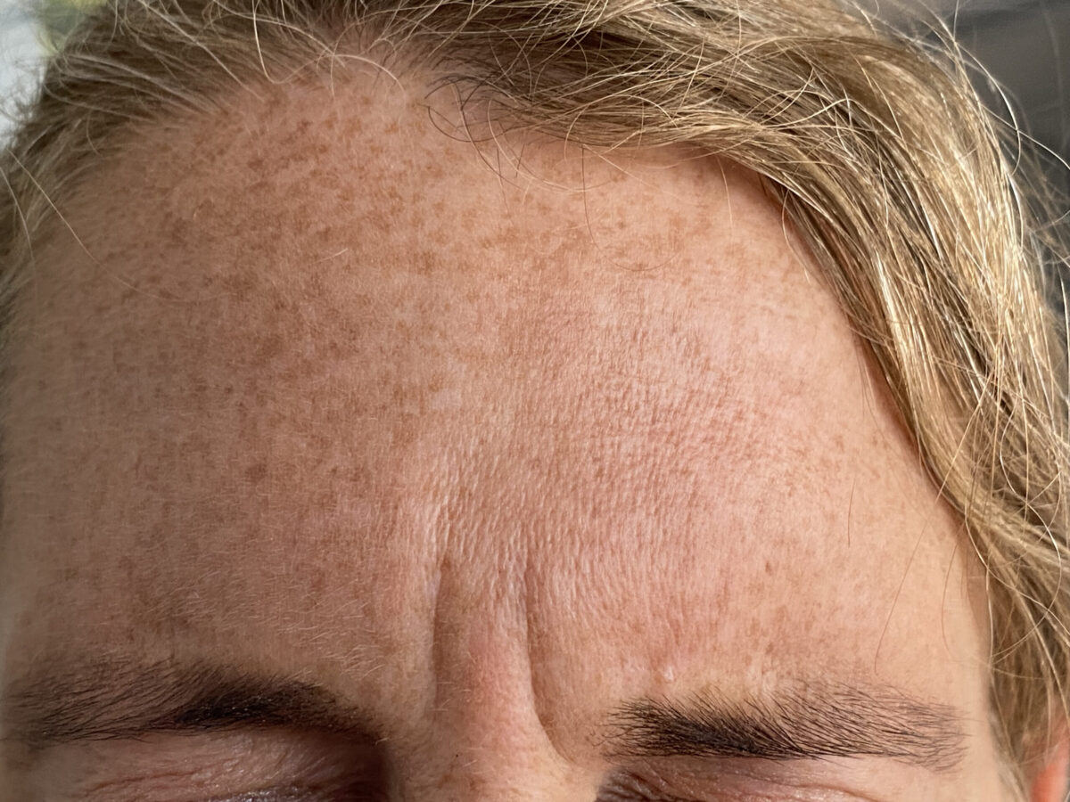 Before Botox For frown Lines