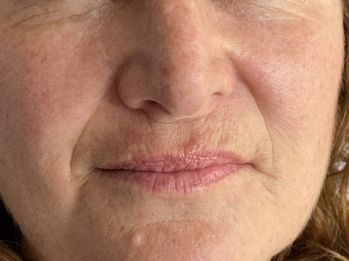 Before Lip Fillers