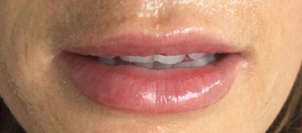 After PDO Threads For Lips