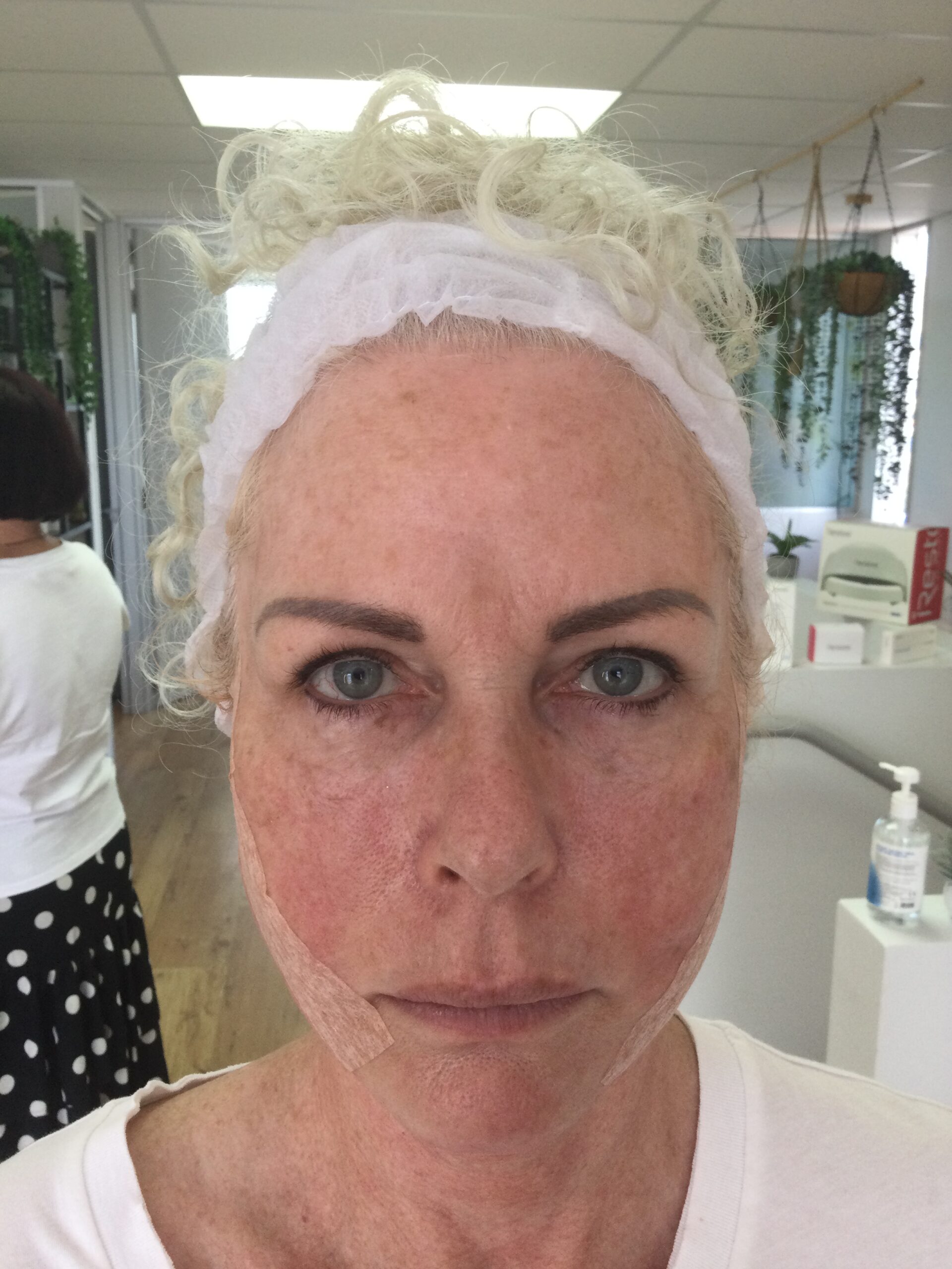 Straight After A PDO Threadlift