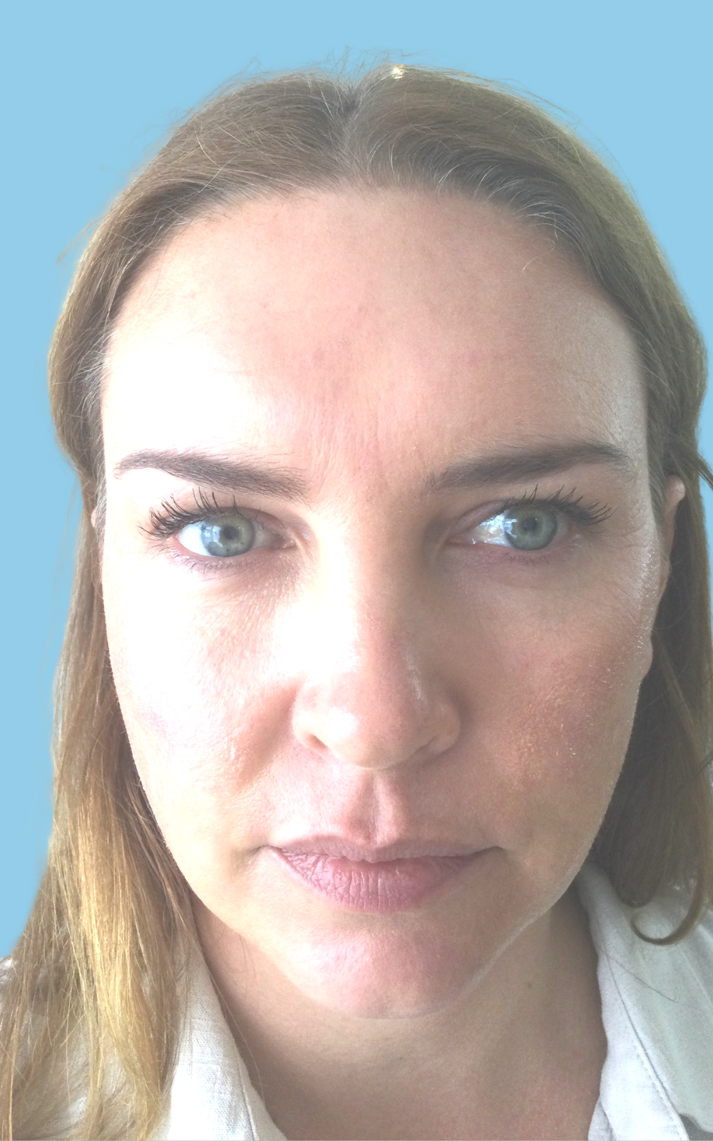 Katrina before Non-Surgical Facelift with PDO Threads