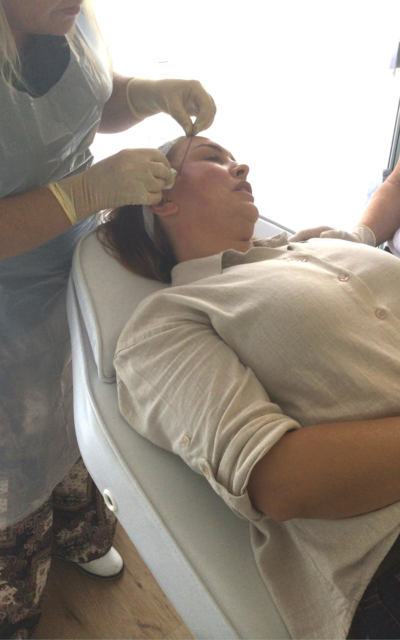 Katrina during a Non Surgical Facelift with PDO Threads