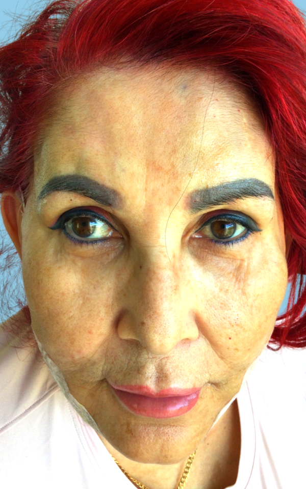 Corrin after PDO Threadlift