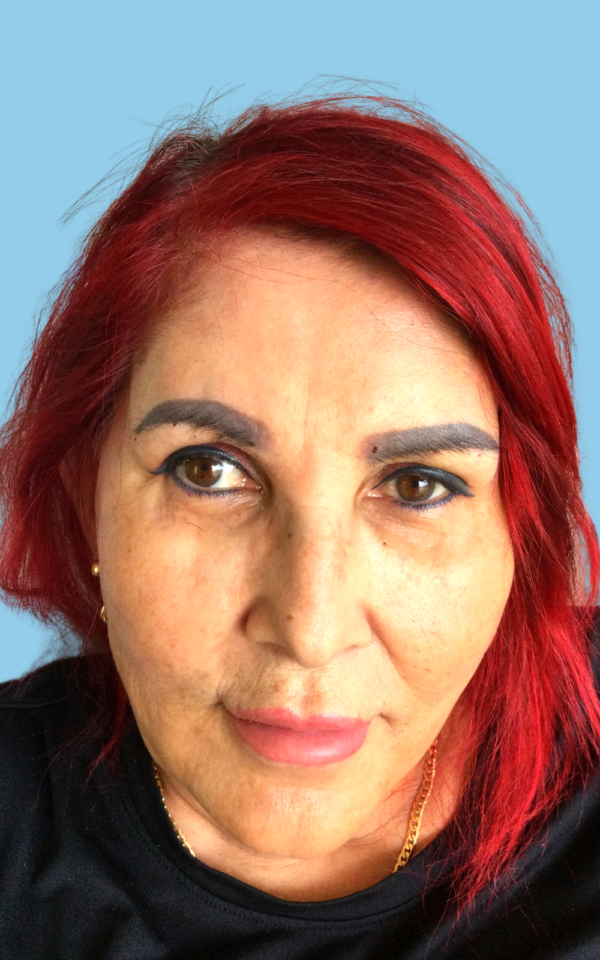 After Non Surgical Facelift with PDO Threads Corrin after PDO Thread Facelift