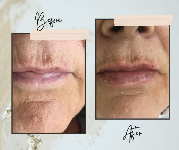 1 ml lip filler before and after Before and after 1 ml of lip filler