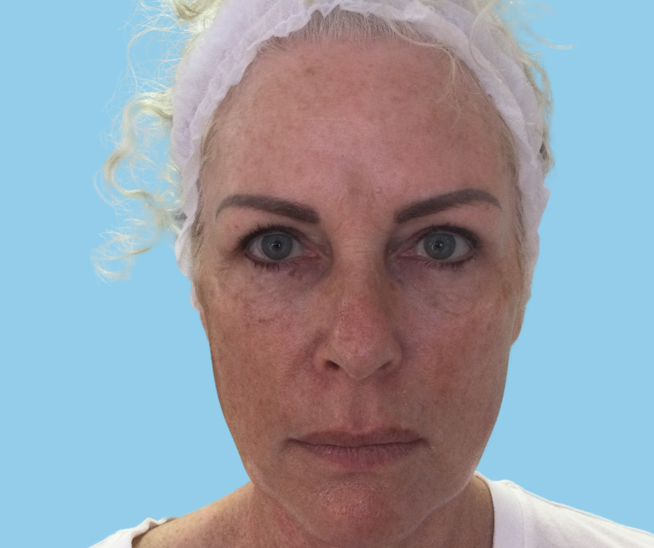 Ingrid Before PDO Thread Facelift